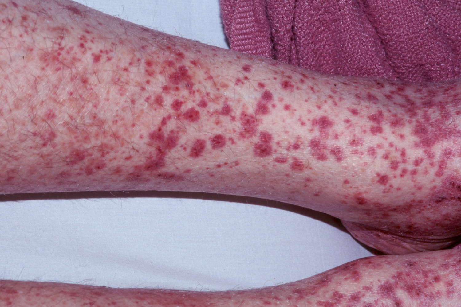 Henoch Schonlein Purpura Causes Symptoms Prognosis Treatment