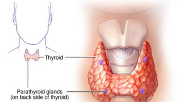 hypoparathyroidism