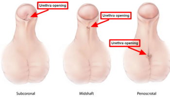 hypospadias