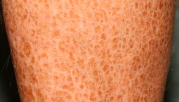 ichthyosis vulgaris