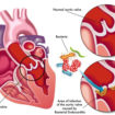 infective endocarditis