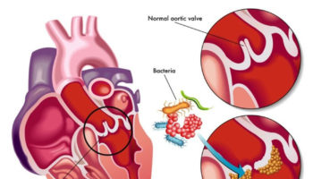 infective endocarditis