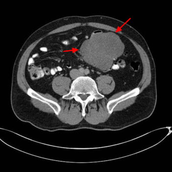 Desmoid Tumor - Causes, Symptoms, Survival Rate, Treatment