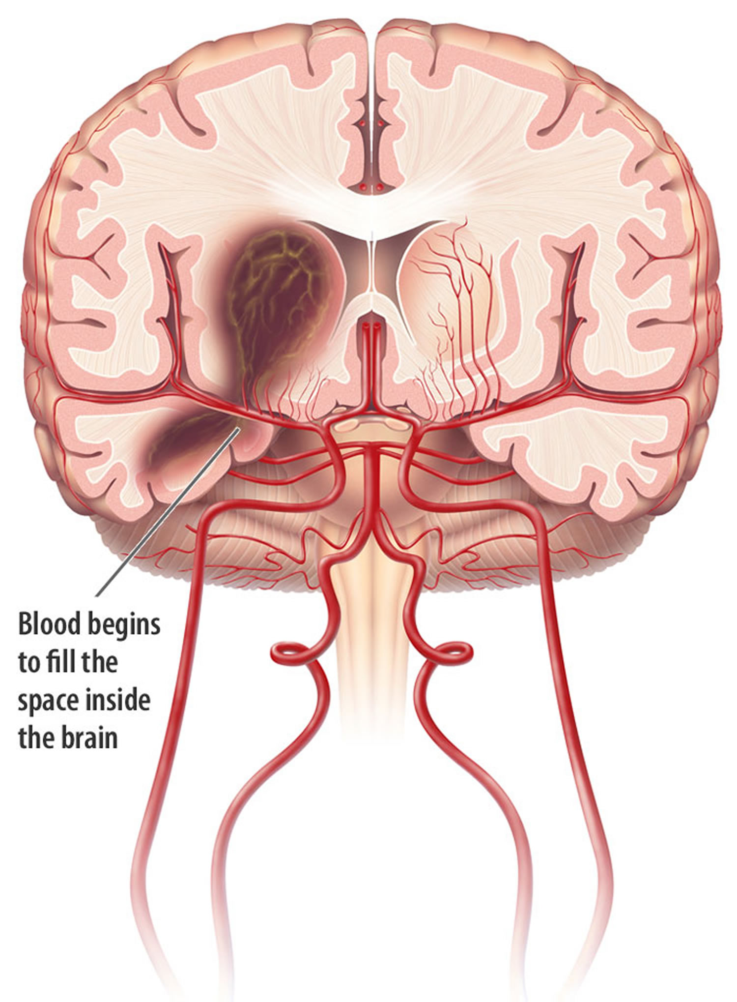 Intracranial Hemorrhage Cause Symptoms Diagnosis Treatment