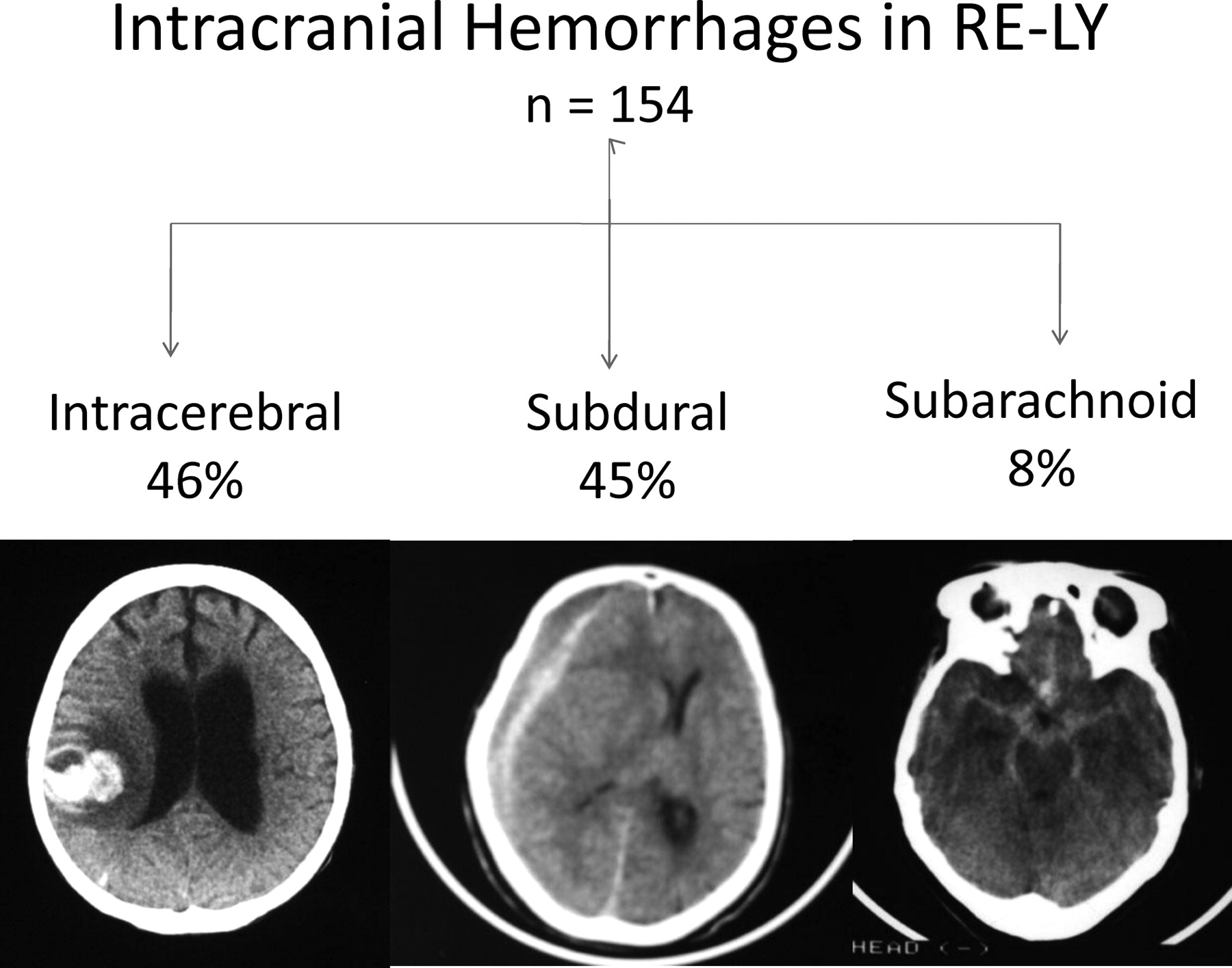 Hemorragia Intracerebral Vs Hemorragia Subaracnoidea