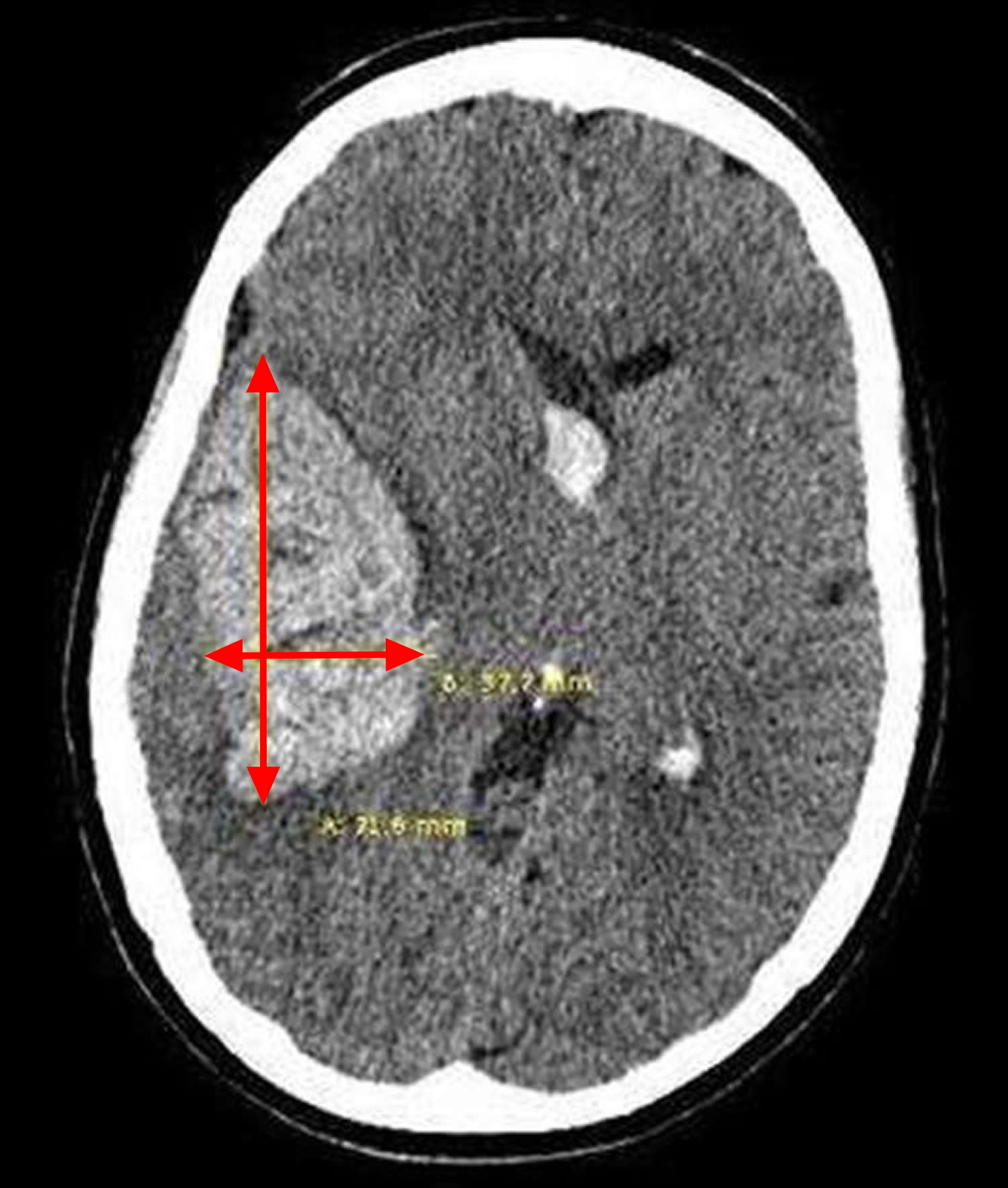 Brain Bleed (Intracranial Hemorrhage): Causes & Symptoms