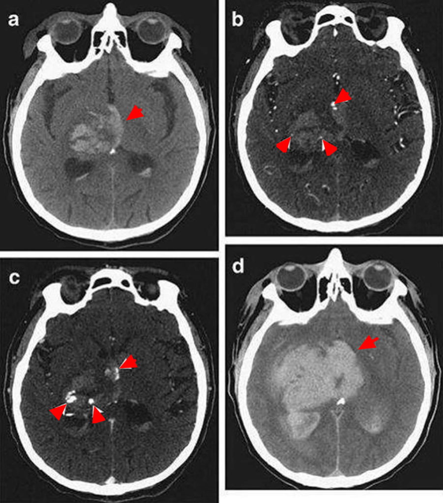 Intracranial Hemorrhage - Cause, Symptoms, Diagnosis, Treatment