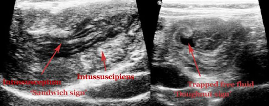 Intussusception Causes, Symptoms, Diagnosis, Treatment