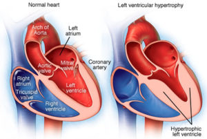 Left Ventricular Hypertrophy - Causes, Symptoms, Diagnosis & Treatment