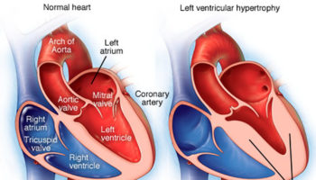 left ventricular hypertrophy