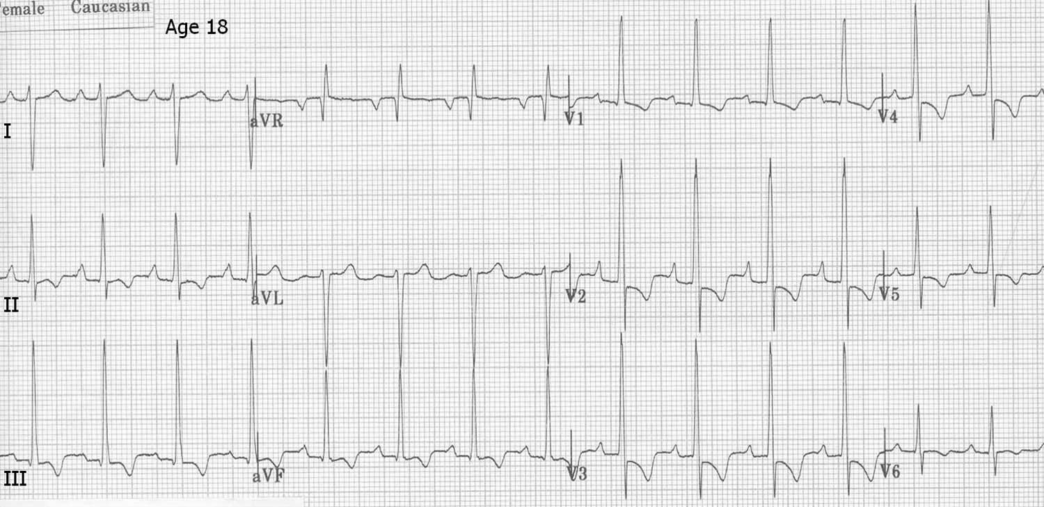 Left ventricular hypertrophy ECG