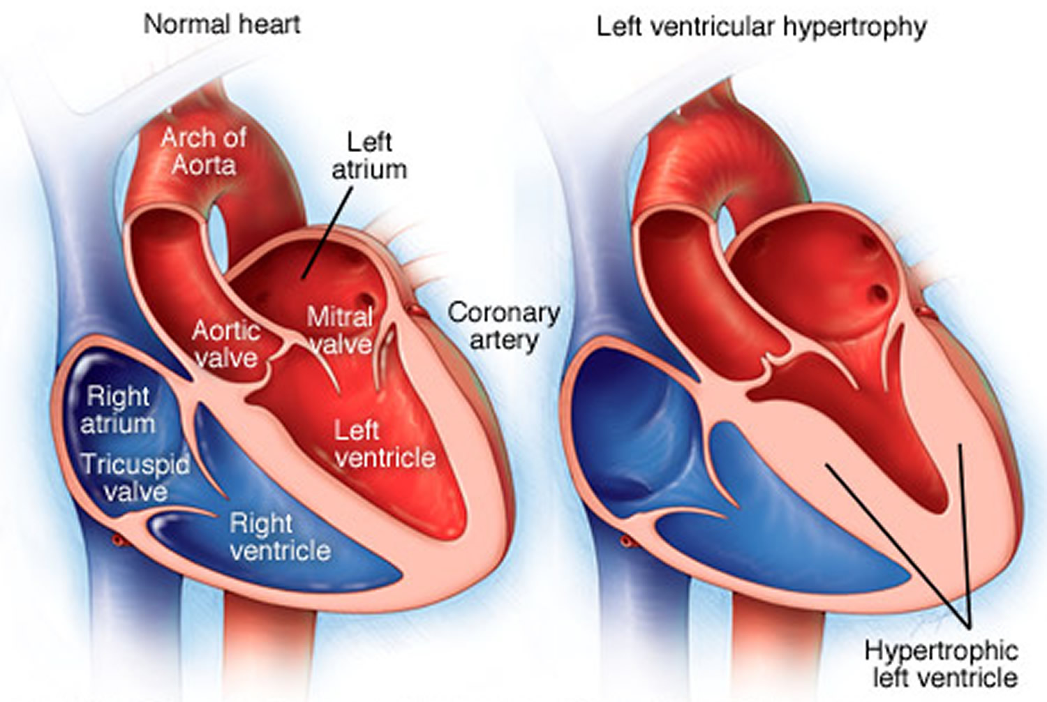 Left Ventricular Hypertrophy Causes, Symptoms, Diagnosis & Treatment