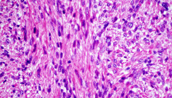 leiomyosarcoma