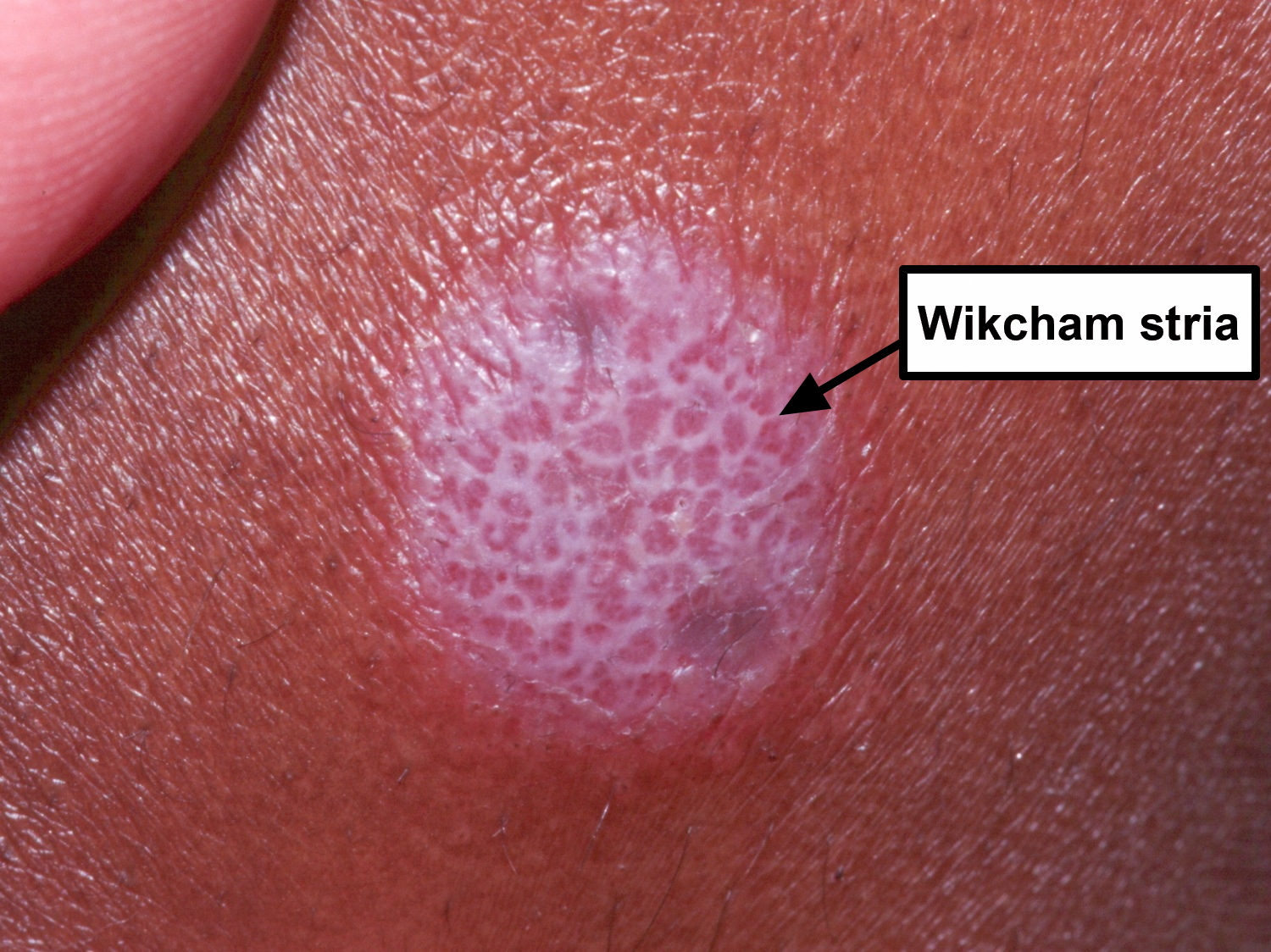 Lichen Planus Skin Rash