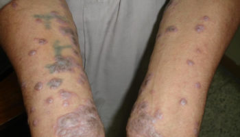 lichen planus