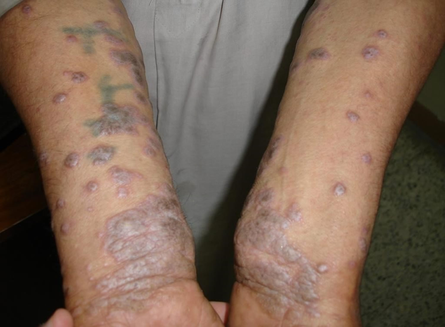 lichen sclerosus on legs