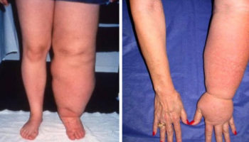 lymphedema