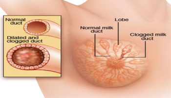 mammary_duct_ectasia