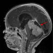 medulloblastoma 1