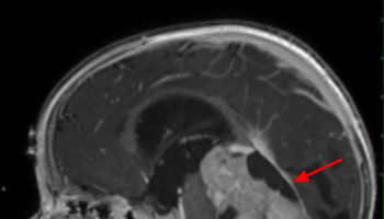 medulloblastoma 1