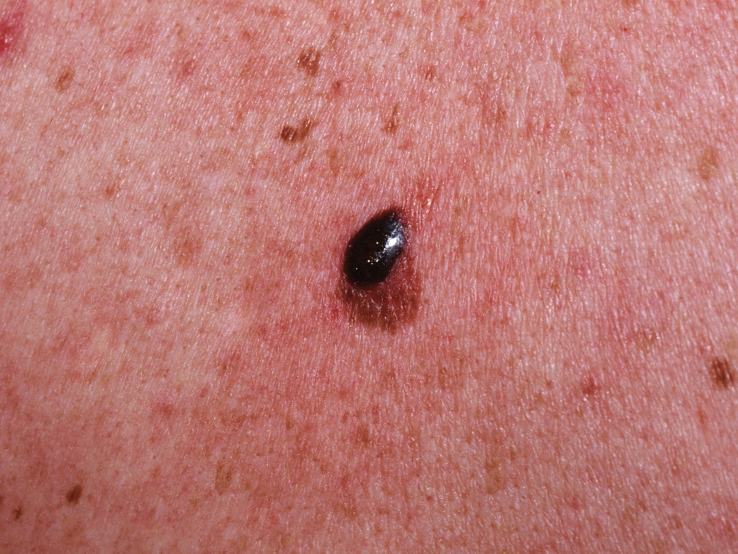 Skin Cancer Melanoma Melanoma And Non Melanoma Skin C