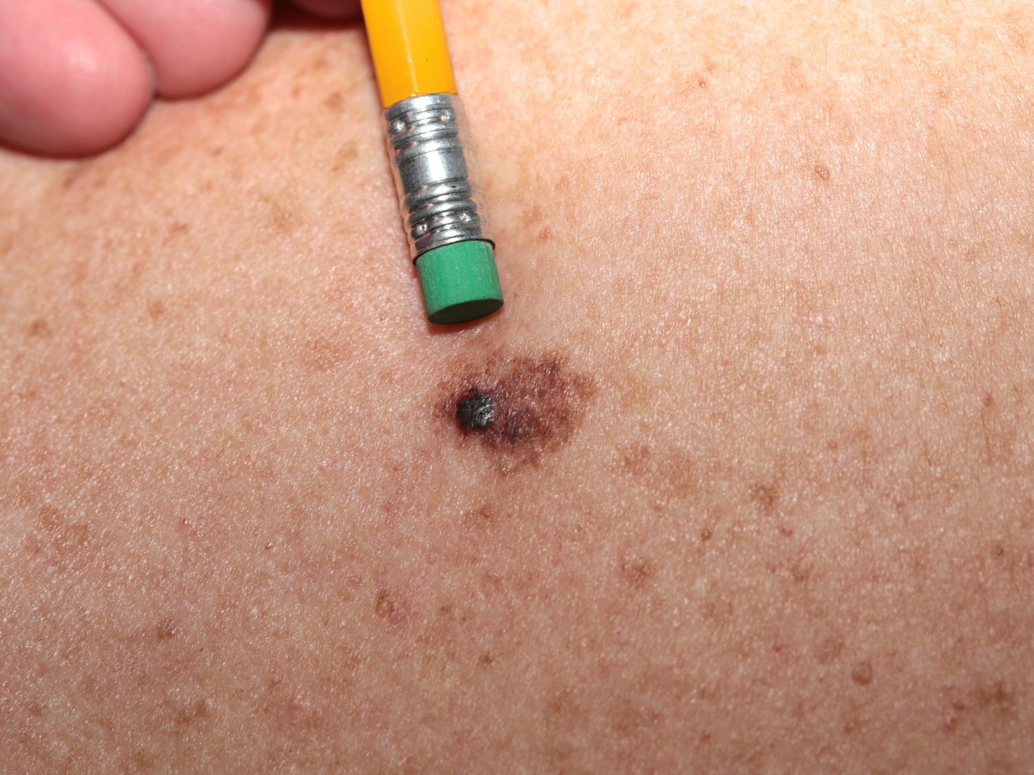 melanoma