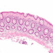 microscopic colitis