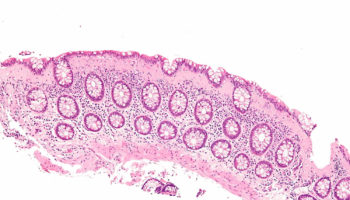 microscopic colitis