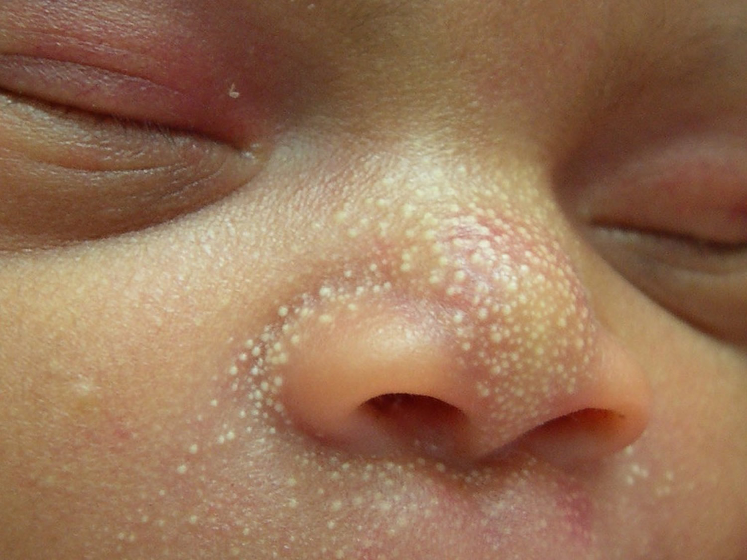 White Dots Around Newborn Mouth