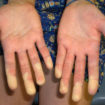 mixed connective tissue disease