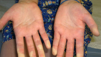 mixed connective tissue disease