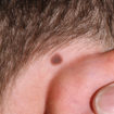 moles