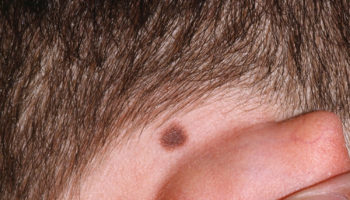 moles