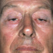 myasthenia gravis