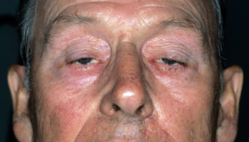 myasthenia gravis