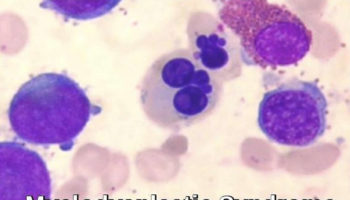myelodysplastic syndrome