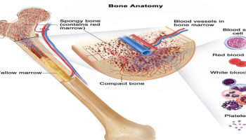 myelofibrosis