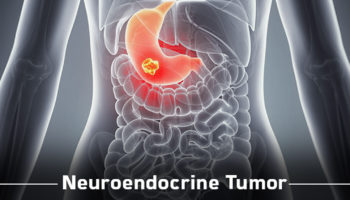 neuroendocrine tumor
