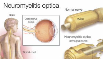 neuromyelitis optica