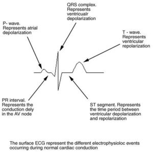 Bundle Branch Block - Causes, Symptoms, Diagnosis, Treatment