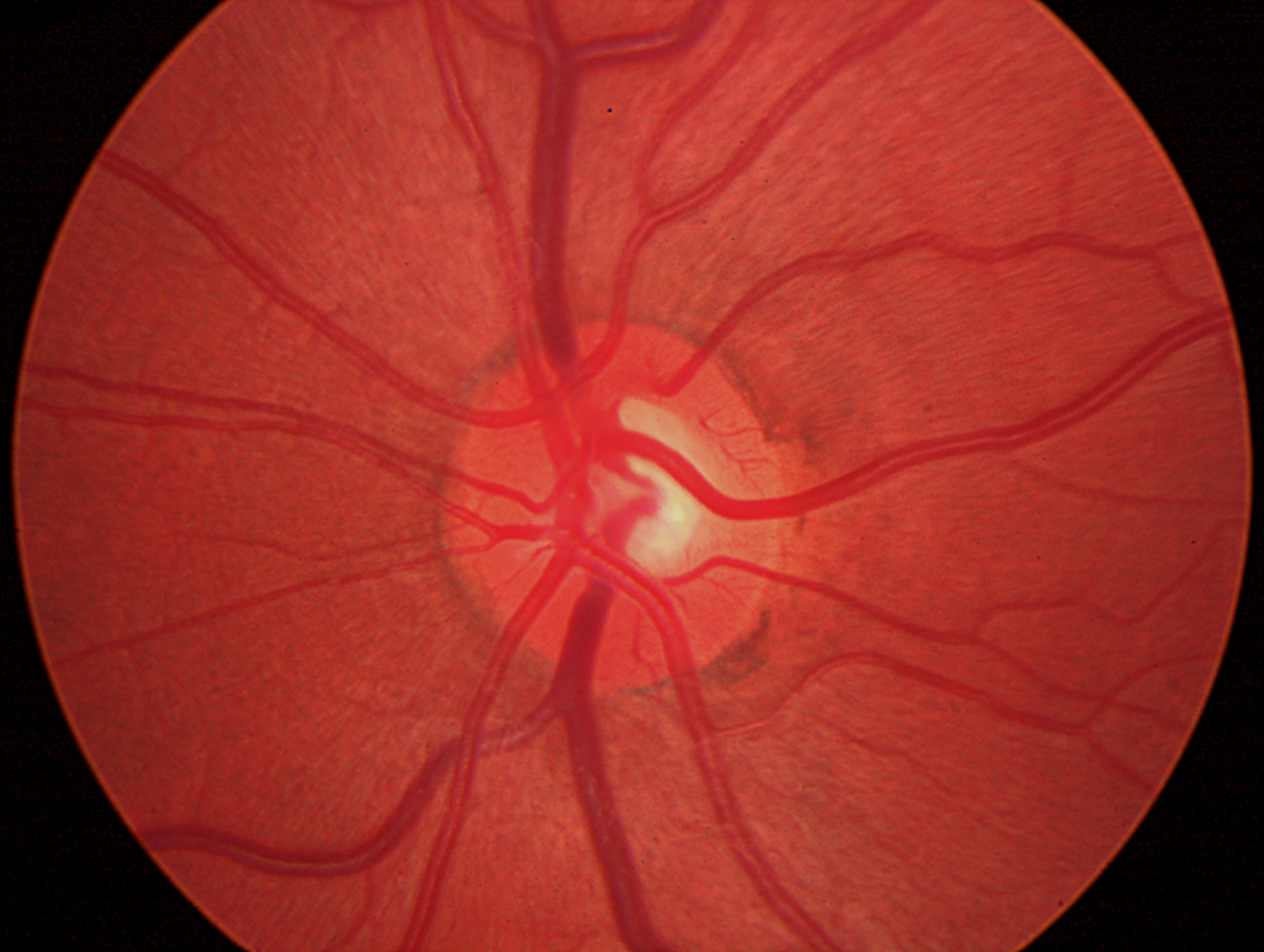 Optic Neuritis Causes Symptoms Prognosis Diagnosis Treatment