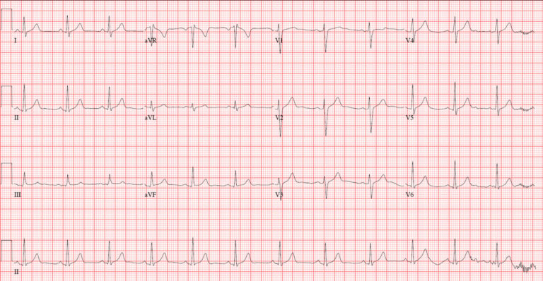 Bundle Branch Block - Causes, Symptoms, Diagnosis, Treatment