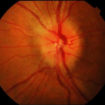 optic neuritis