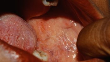 oral lichen planus