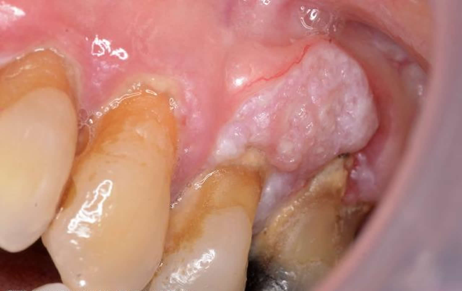 oral lichen planus cancer
