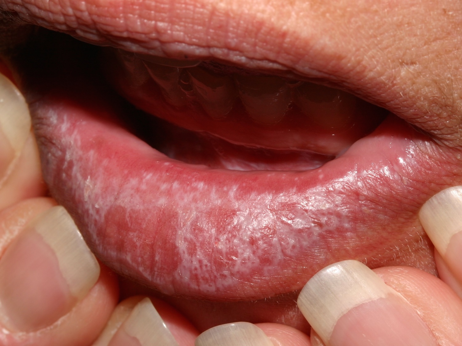 oral lichen planus - lip