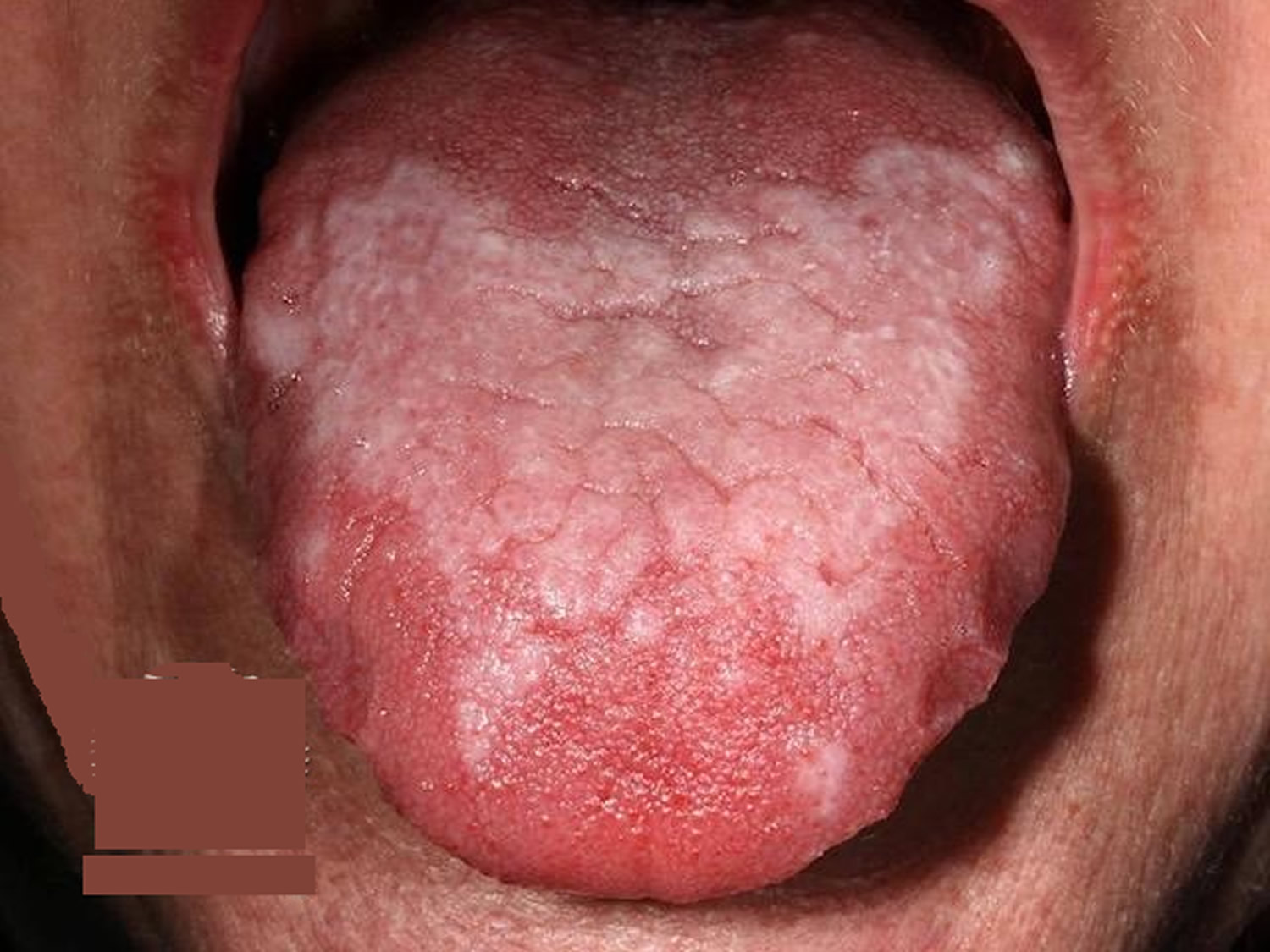 Oral lichen planus tongue