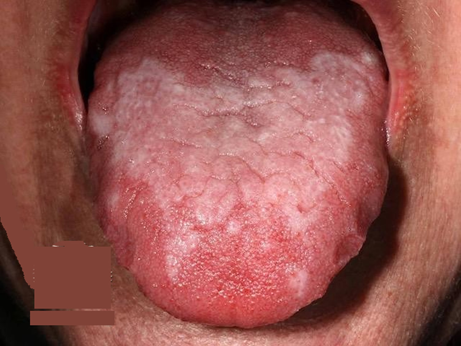 Oral Lichen Planus Cheek Hot Sex Picture