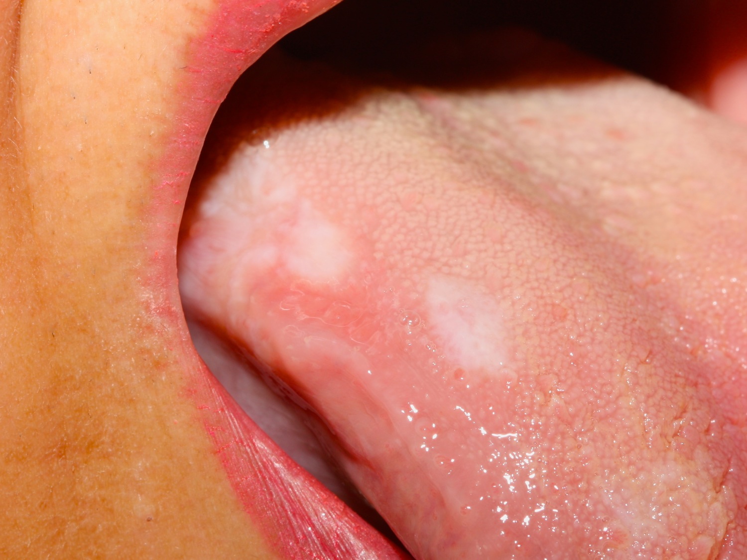 oral lichen planus tongue