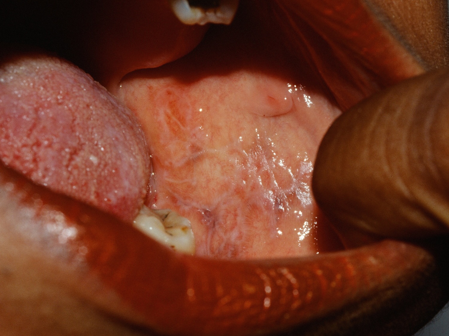 oral lichen planus